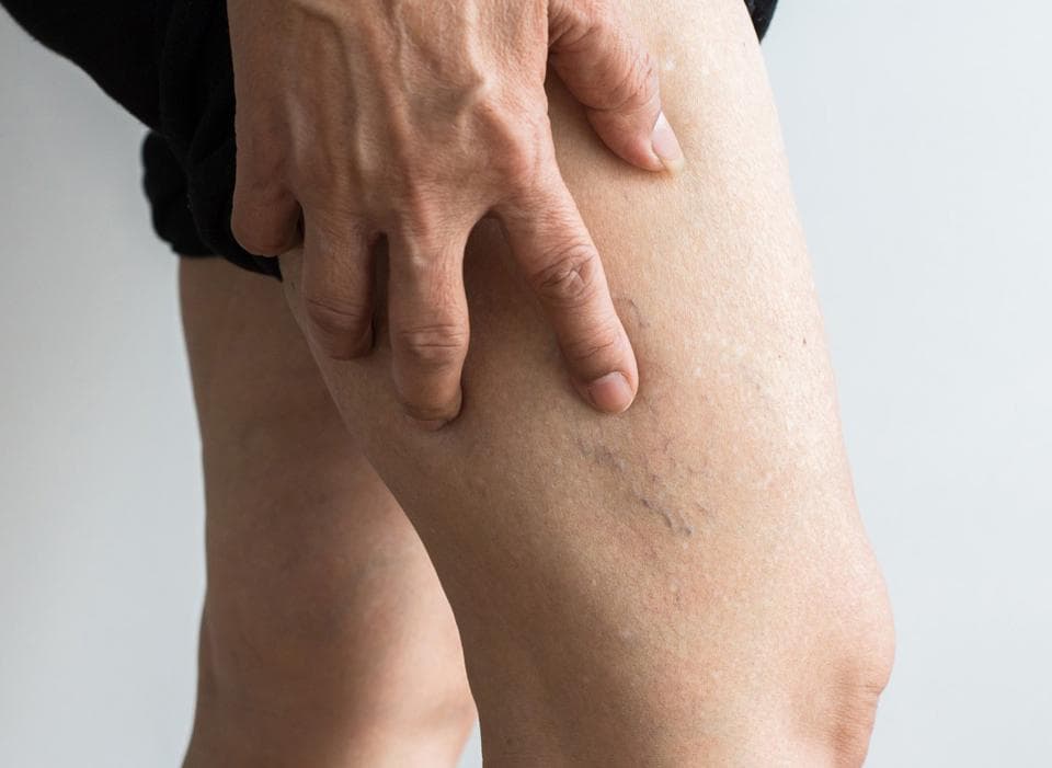 Telangiectasias en las piernas: de dónde salen las arañitas vasculares y cómo tratarlas